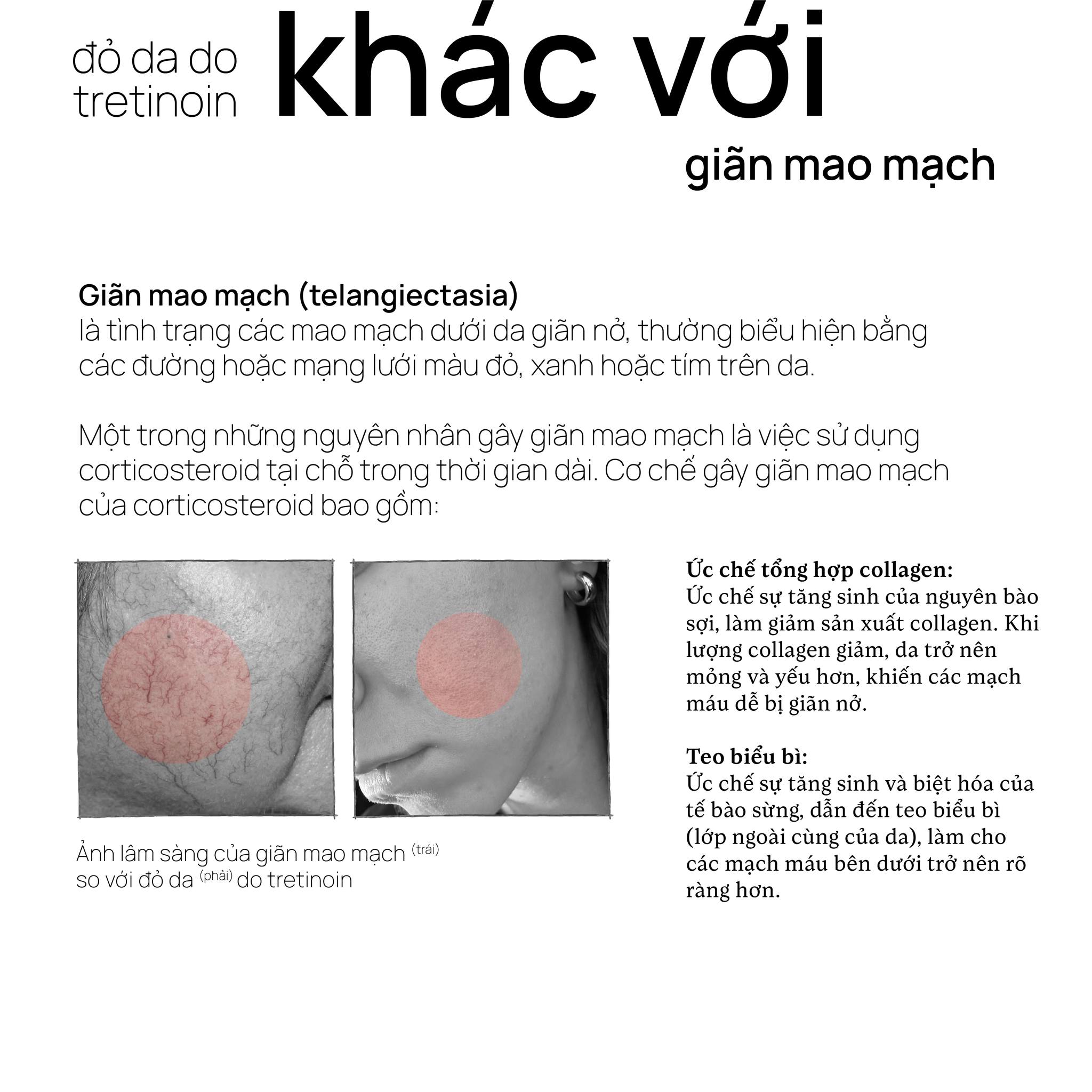 Đỏ da do tretinoin khác với giãn mao mạch