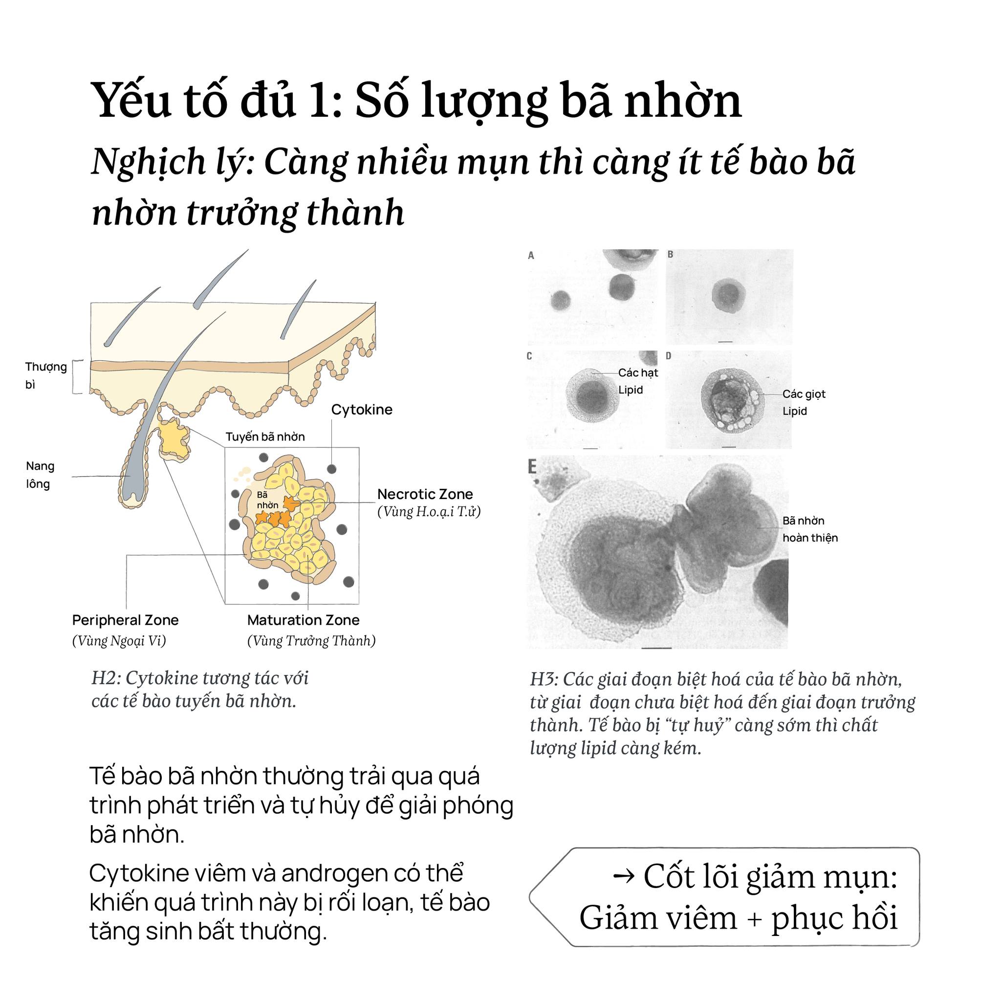 Yếu tố đủ 1: Số lượng (tế bào) bã nhờn Nghịch lý: Càng nhiều mụn thì càng ít tế bào bã nhờn trưởng thành