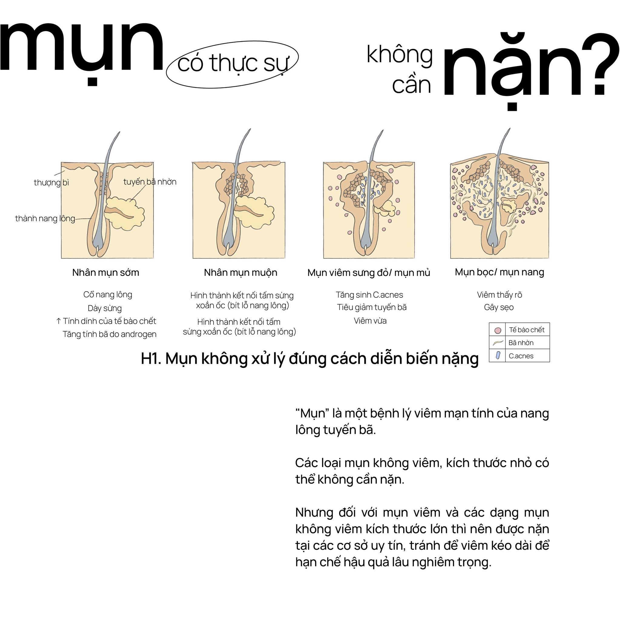 Có thực sự không cần nặn mụn