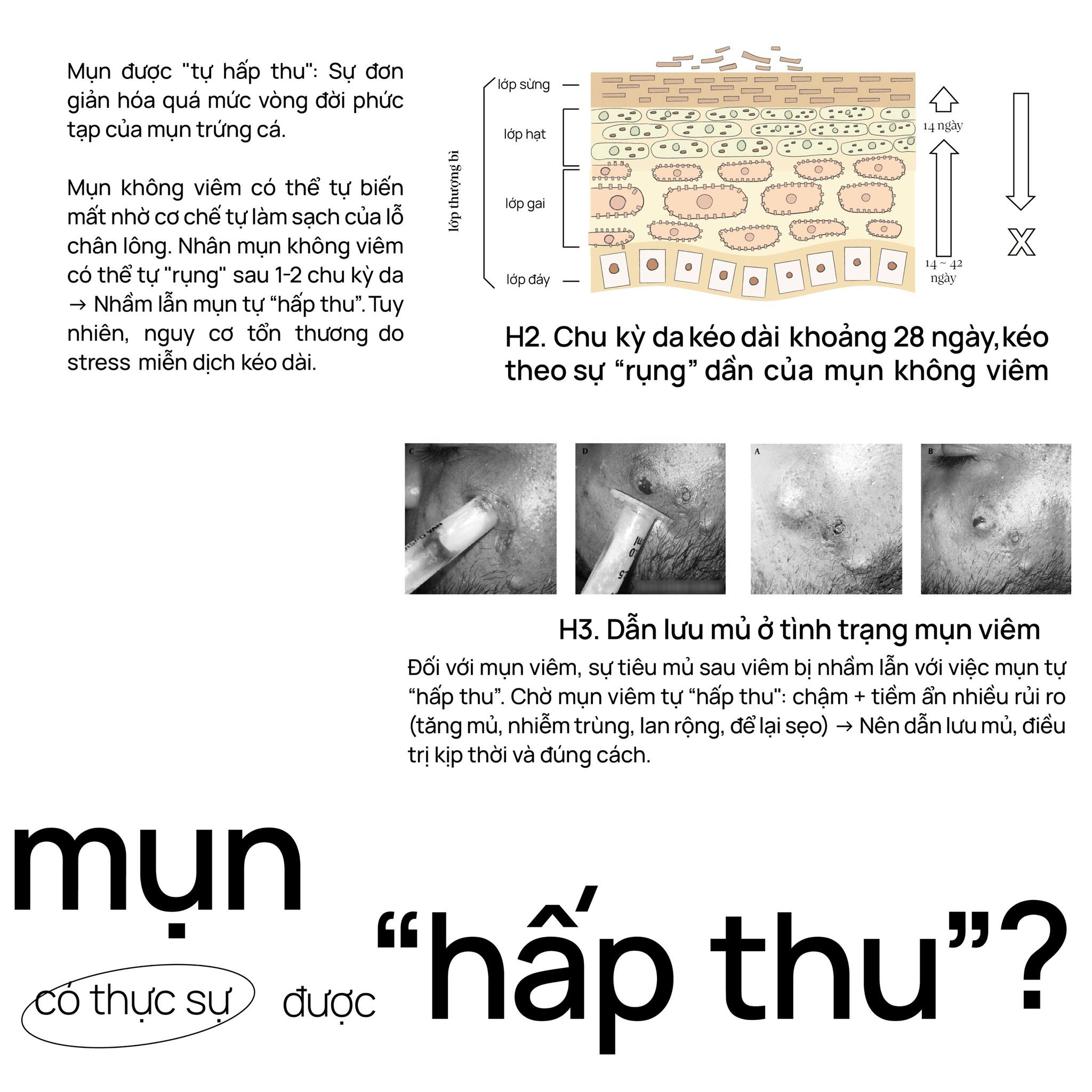 Mụn có thực sự được tự hấp thu