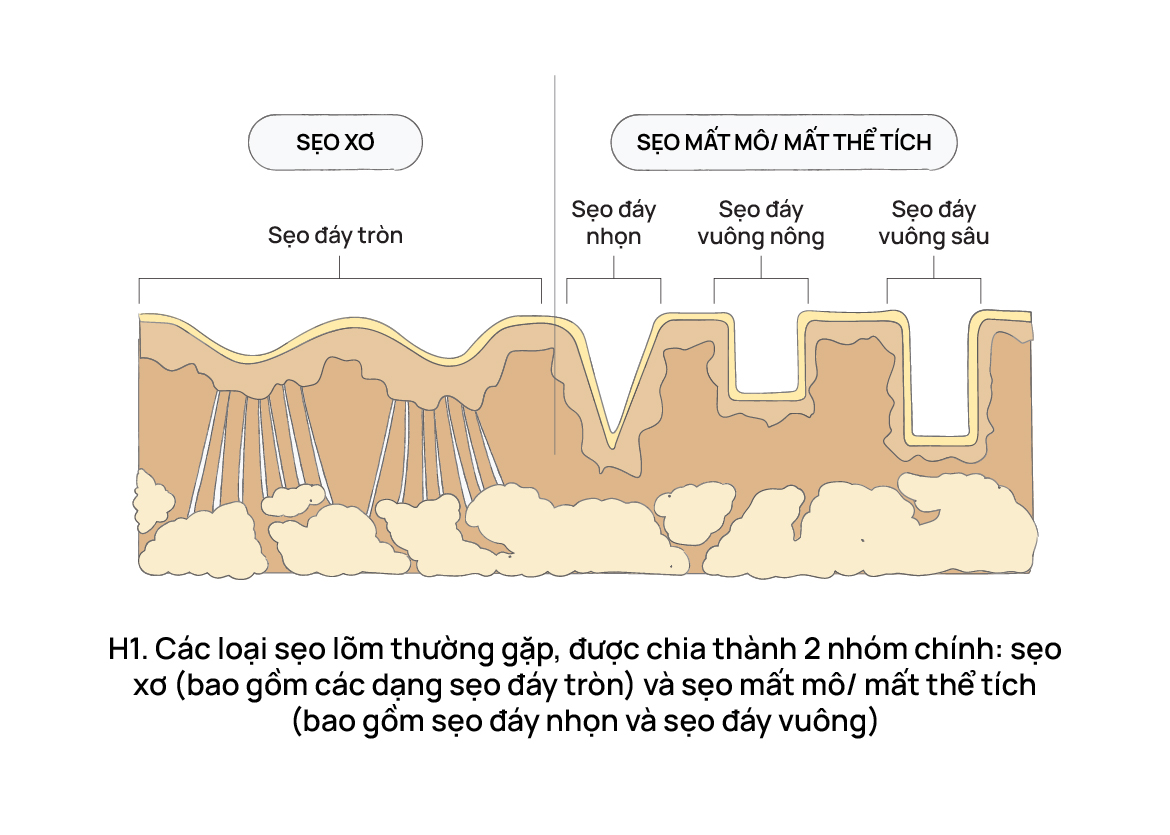 Các loại sẹo rỗ thường gặp, được chia thành 2 nhóm chính: sẹo xơ (bao gồm các dạng sẹo đáy tròn) và sẹo mất mô/mất thể tích (bao gồm sẹo đáy nhọn và sẹo đáy vuông).